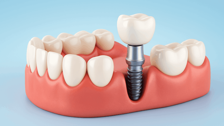 Кейс по имплантации зубов